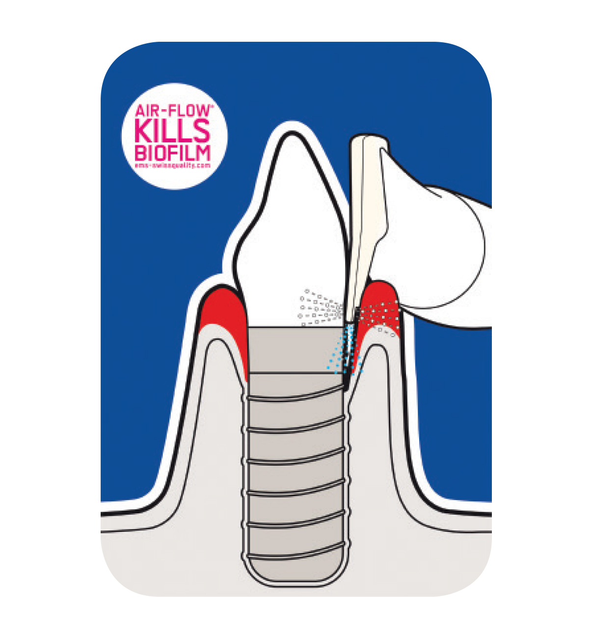 EMS накрайник Perio Nozzles  за скалер 10 бр.